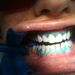 Nagy a kontraszt a kék ínyvédő és a fehér fog között