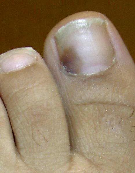 Raynaud-kór miatt nem csak az ujjak,de a körmök is elszíneződhetnek.