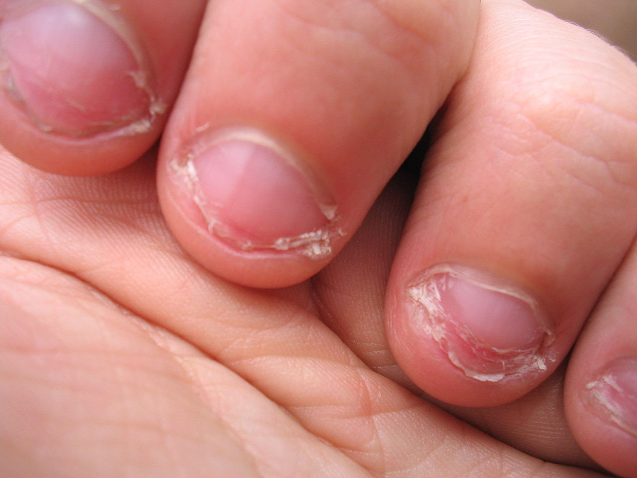 Raynaud-kór miatt nem csak az ujjak,de a körmök is elszíneződhetnek.